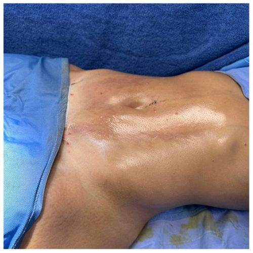 Collage-liposcultura-napoli-2048x1034 copia