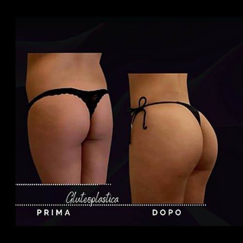 Gluteoplastica