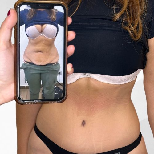 lipoaddominoplastica-dottor-giuseppe-scalera-napoli